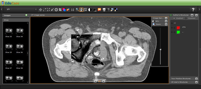 EduCase, Features, Contouring Tools, Spyglass Tools for DICOM images
